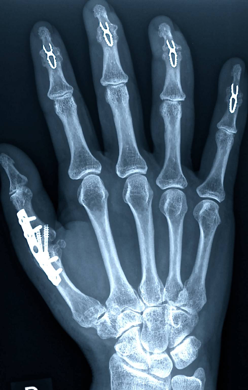 Heidemann Hand Und Ellenbogenchirurgie In H rth Handchirurgie heidemann-hand-und-ellenbogenchirurgie-in-h-rth-handchirurgie
